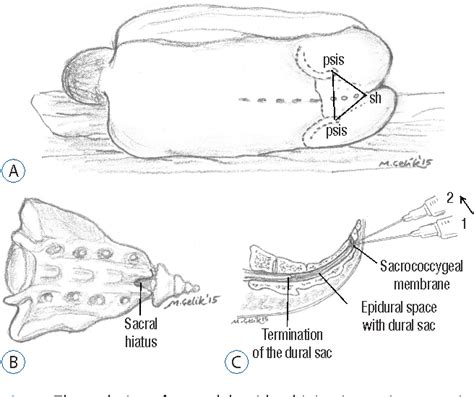 Figure 1 From Impact Of Position On Efficacy Of Caudal Epidural