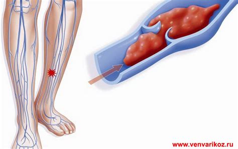 Лечение тромбофлебита