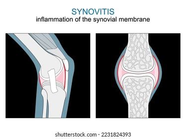 Bursitis Prepatellar Bursitis Inflammation Sacs Synovial Stock Vector ...