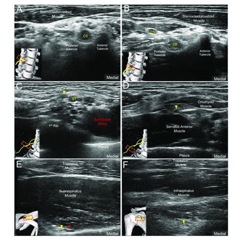 | Ultrasound imaging of (A) C5 nerve root, (B) C6 nerve root and the ...