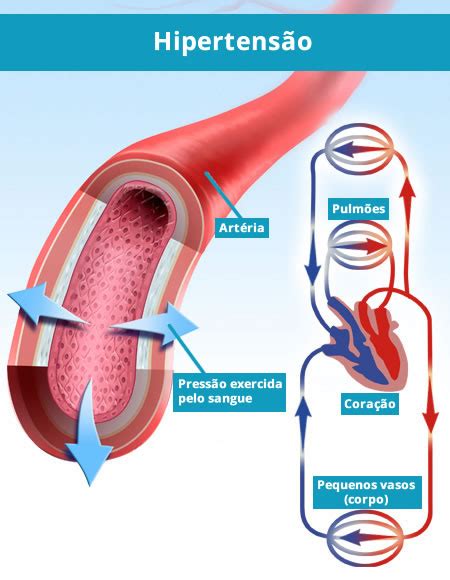 O Que Press O Alta Ou Hipertens O Medsimples