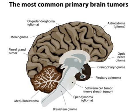 Meningioma : Facts, symptoms, complications, treatment, & care | FactDr