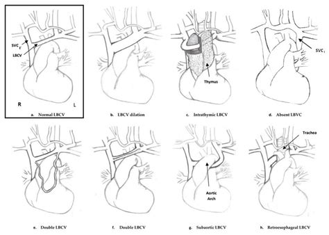 Brachiocephalic Vein