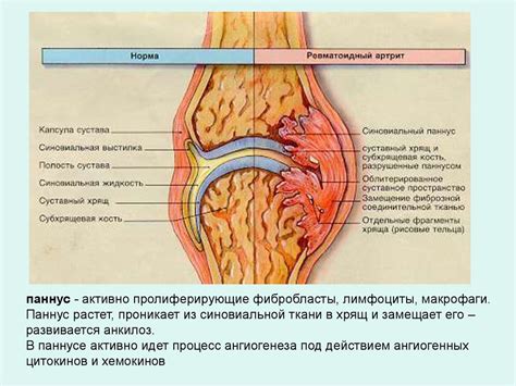 Ревматоидный артрит - презентация онлайн