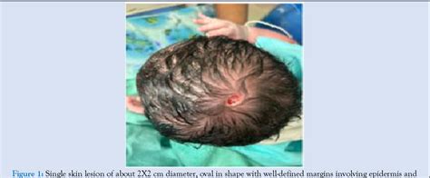 Figure 1 From Aplasia Cutis Congenita Mimicking As Scalp Birth Injury