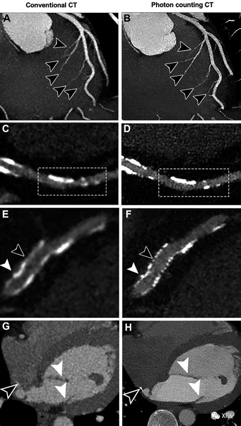 心脏ct最新进展下：心肌ecv，心肌应变与光子计数ct冠状动脉ct心肌计数 健康界