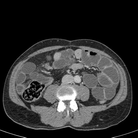 The Radiology Assistant Closed Loop Obstruction In Small Bowel Obstruction