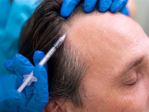 Prp Treatment For Hair Loss Vancouver Clinic