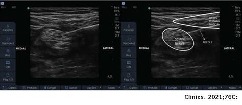 continuous peripheral nerve block   patients   limb