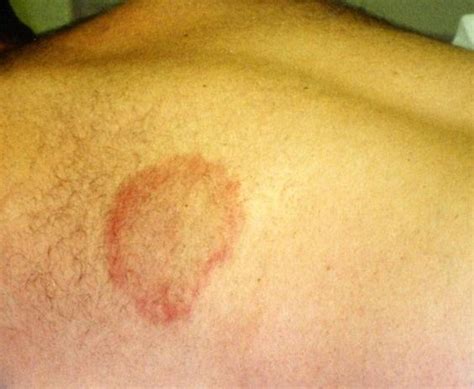 Liver Disease Itchy Skin Rash