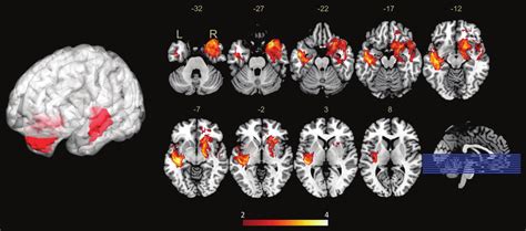 Voxel Based Lesion Symptom Mapping Defined P High Mutant Regions