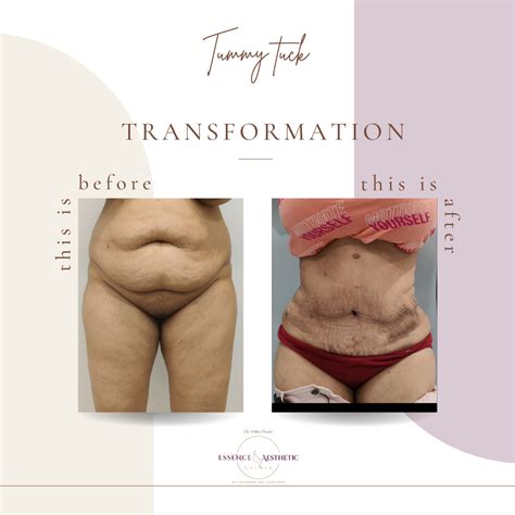 Tummy Tuck Abdomino Plasty Essence Aesthetic