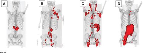 Figure From Molecular Profile And Fdg Pet Ct Total Metabolic Tumor