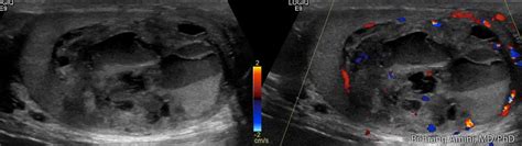 Roentgen Ray Reader Mixed Germ Cell Tumor Of The Testis