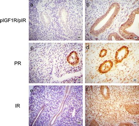 Insulin IGF And Sex Hormone Axes Protein Expression In Endometrium In