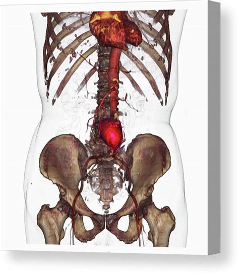 Ct Scan Image Showing An Abdominal Aortic Aneurysm Canvas Print Canvas Art By Callista Images