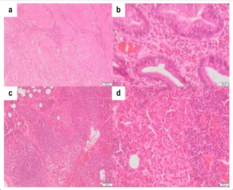 Biopsy Gastric Showing Areas Of Increased Eosinophilic Infiltration A