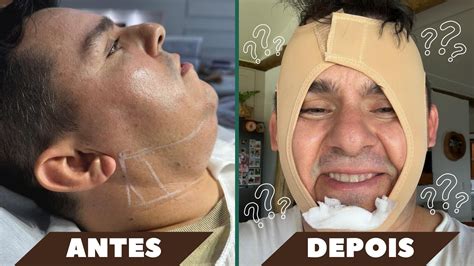 Cirurgia De Papada Antes E Depois - FIZ A LIPO DE PAPADA, VEJA O ANTES E DEPOIS - TRANSFORMAÇÃO INCRÍVEL ...