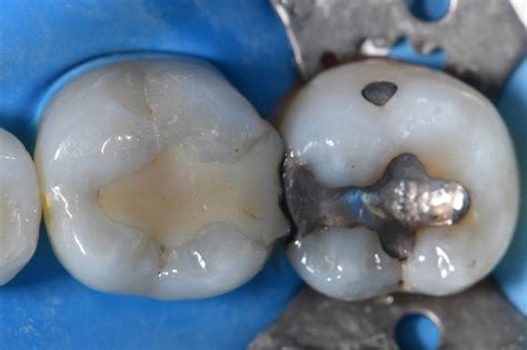 Simple Shade Selection Composite Resin | Kerr Simplishade