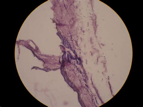 Histopathology Showing Thin Walled Cyst Lined By Flattened And Cubical