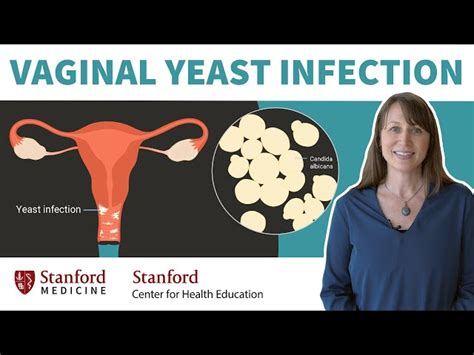 How To Cure Vaginal Yeast Infection Outlet | www.aikicai.org