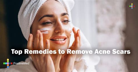 Top Remedies to Remove Acne Scars