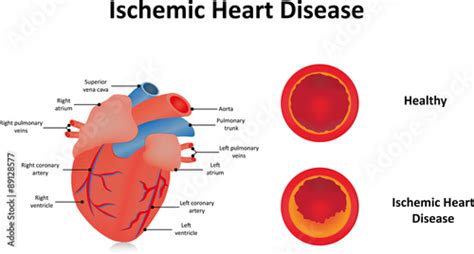 Ischemic Heart Disease Illustration Stock Vector | Adobe Stock