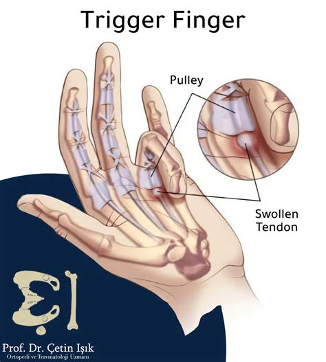 Hand tendonitis; Its problems and ways to solve them - Dr. What's wrong ...