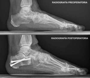 PIE PLANO VALGO Diagnóstico y tratamiento icatpie