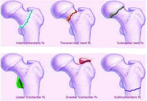 Figure Femoral Neck Fracture Image Courtesy S Bhimji Md Statpearls Ncbi Bookshelf