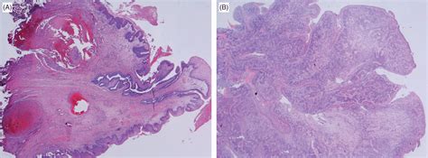 Urethral Caruncle Histology
