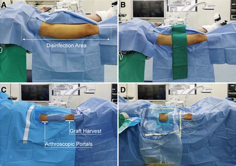 Modified Technique For Labral Reconstruction Of Hip Joint Using