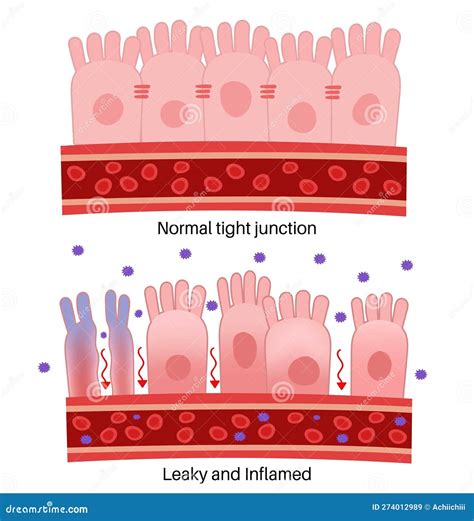 Leaky Gut Syndrome or Intestinal Hyperpermeability. Stock Vector ...