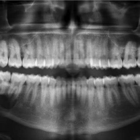 Panoramic X Ray Shows A Large Multilocular Radiolucent Lesion In The