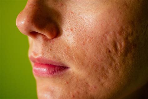 imaging technique measures severity  atrophic acne scars