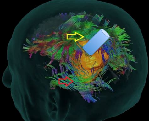 Minimally Invasive Brain Surgery