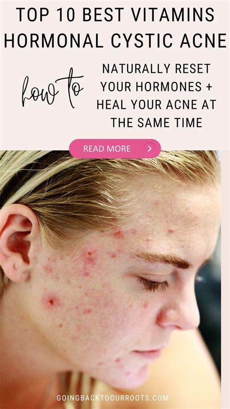 Managing Hormonal Acne Artofit