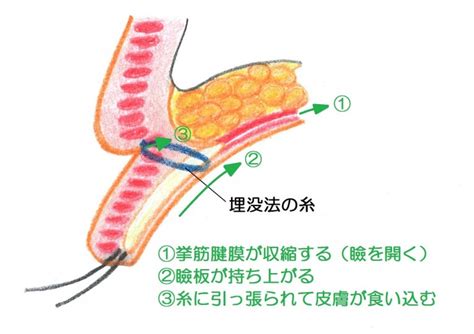 取れにくい埋没法を目指して～その① | 神戸三宮駅徒歩3分のこうべ花時計クリニック