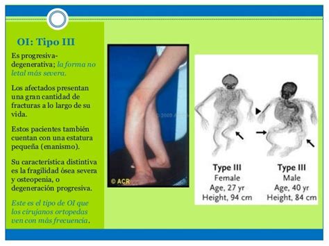 Osteogénesis Imperfecta Up Med