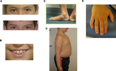 Síndrome De Xyy - 47,XYY Syndrome: Clinical Phenotype and Timing of Ascertainment - The ...