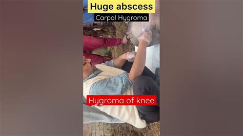 Hygroma Of Knee L Carpal Hygroma L Dr Umar Khan Youtube