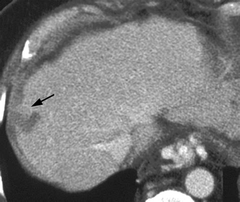 Tumor Recurrence After Radiofrequency Thermal Ablation Of Hepatic