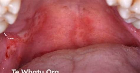 Oral Pemphigus Vulgaris Image