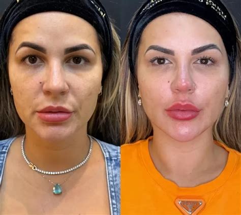 Dra Deolane faz outra harmonização facial e tira preenchimento labial