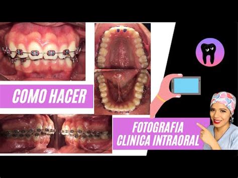 Como Hacer Fotograf A Cl Nica Intraoral Con El Celular Youtube