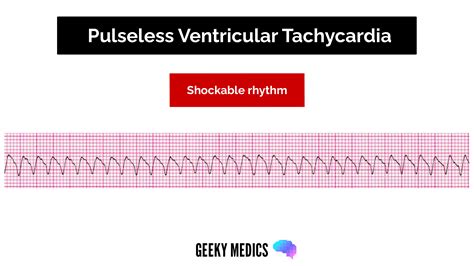 Shockable vs. Non-shockable Rhythms in Cardiac Arrest | Geeky Medics