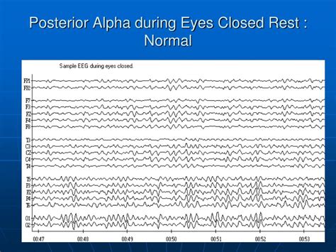 Ppt Electroencephalography Eeg Brainwaves Powerpoint Presentation