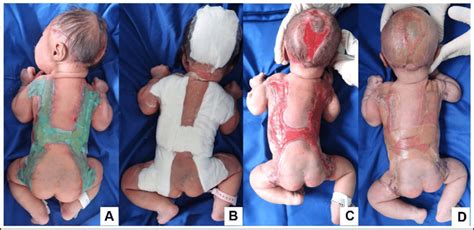 WD Used On The Patient Initially Lesions Were Treated With Sorbact