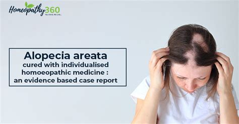 Alopecia Areata Cured With Individualised Homoeopathic Medicine An