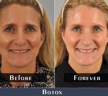 Best Botox Treatment In Gurgaon